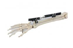 China Sterilized Bone Fracture Distal Radius External Fixator supplier