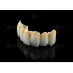 High Translucency Full Contour Zirconia Bridge Chipping Resistance Natural Esthetics