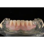 Personalized Invisible Denture Finished With Advanced Tooth Arrangement Technology for sale