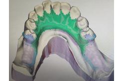 China Removable 3D Printed Partial Denture Metal Framework supplier