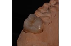 China Full Contour Translucent Zirconia Crown for Aesthetically Pleasing Results supplier