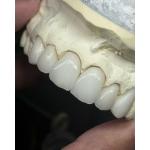 Transluency Layered Zirconia Crown for Optimal Functionality and Natural Aesthetics for sale