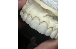 China Transluency Layered Zirconia Crown for Optimal Functionality and Natural Aesthetics supplier