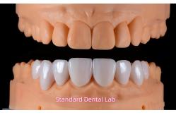 China Dental PFM Crown manufacturer