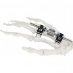 Orthopedic Surgical Mini Fragment Ilizarov External Fixation Device
