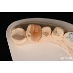 Zirconia Inlay Onlay With Adhesive Cementation For Damaged Teeth Restoration for sale