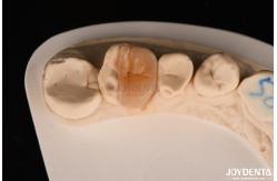 China Zirconia Inlay Onlay With Adhesive Cementation For Damaged Teeth Restoration supplier