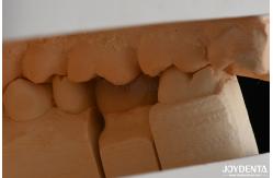 China Custom Compound Inlay Onlay For Minimally Invasive Dental Restoration supplier