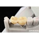 Experience Aesthetically Pleasing Results With Customizable Implant Retained Crown And Bridge