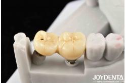 China Experience Aesthetically Pleasing Results With Customizable Implant Retained Crown And Bridge supplier
