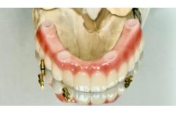 China Dental All On X Implant PFM Crown Titanium Fixed Hybrid Denture supplier