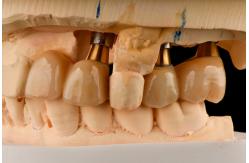 China Self Tapping 3.0mm Thread Dental Titanium Implant Optimized Functionality supplier