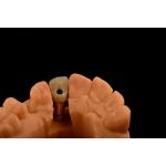 Internal Hex 3.0mm Depth 1.5mm Pitch Single Titanium Tooth Implant Replacement