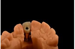 China Internal Hex 3.0mm Depth 1.5mm Pitch Single Titanium Tooth Implant Replacement supplier