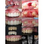 Multilayered Gradient Technology Dental Zirconia Safe And Aesthetically Pleasing For Long-term for sale