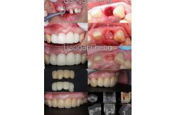 China Multilayered Gradient Technology Dental Zirconia Safe And Aesthetically Pleasing For Long-term supplier