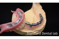 China Titanium Implant Supported Dentures Precise Ivoclar Denture Over Implants supplier