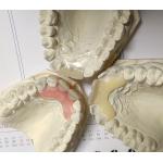 Resin Metal Free Invisible Denture For Allergic Patient for sale