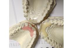 China Resin Metal Free Invisible Denture For Allergic Patient supplier