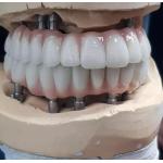 Precision-Crafted Zirconia Implant Screw Cement Retained for Natural-Looking Teeth for sale