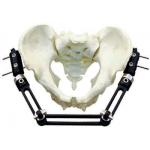 Pelvic Fracture Orthopedic External Fixator Implant Materials For Trauma Operation for sale