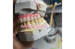 China Screw Retained Titanium PMMA Dental Bridge Temporary Crown supplier
