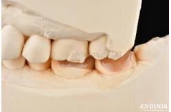 China Customizable Shape Composite Inlays And Onlays Dental Stain Resistance Long Lasting supplier