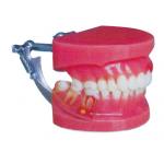 China Red and White Periodontal Disease Demonstration Human Teeth Model General Doctor for sale