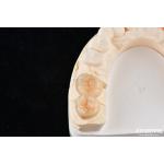 Natural Looking Dental Zirconia Inlays And Onlays High Esthetically Precise Fit for sale