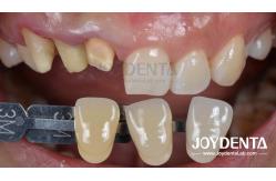 China Painless Procedure BOPT Dental Technique for Accurate Tooth Preparation supplier