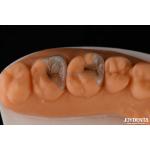 Composite Inlays And Onlays For Dental Restoration Strong Bonding To Tooth Structure for sale