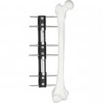 Pediatric LRS system orthofix Limb Lengthening External Fixator for sale