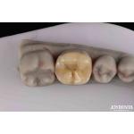 Customizable Zirconia Inlay Onlay Minimal Preparation For Damaged Teeth Restoration for sale