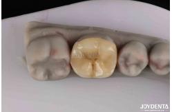 China Customizable Zirconia Inlay Onlay Minimal Preparation For Damaged Teeth Restoration supplier