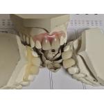 Comfortable Fit ISO13485 RPD Soft Invisible Denture for sale