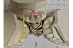 China Comfortable Fit ISO13485 RPD Soft Invisible Denture supplier