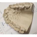 Metal Ceramic Good Fitness PFM Dental Crown for sale