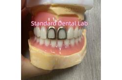 China ISO Full Acrylic Dentures With Yellow Gold Teeth Open Face supplier
