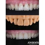 Grassshopper Veneers The Perfect Solution For Natural Translucency Dental Veneers for sale