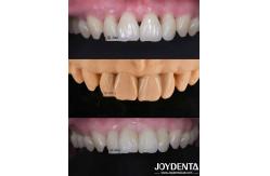 China Grassshopper Veneers The Perfect Solution For Natural Translucency Dental Veneers supplier