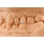 Customizable White Composite Inlay Onlay Natural Looking Minimally Invasive Tooth Restoration