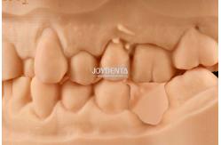 China Customizable White Composite Inlay Onlay Natural Looking Minimally Invasive Tooth Restoration supplier