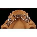 Upper Cast Metal Framework Partial Dentures Strong Lightweight And Durable