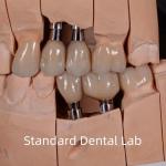 Natural Looking Esthetic Screw Retained Zirconia Implant Crown for sale