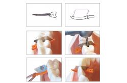 China Dental Sectional Matrix System Wedge Guards M3 3.0 supplier