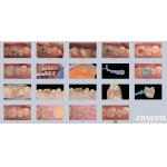 Adults Children Porcelain Ceramic Dental Inlay Restorative for Damaged Teeth for sale