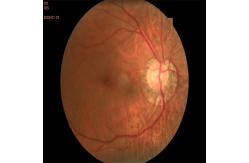 China Autoexposure Automated Fundus Camera FFA Non Mydriatic supplier