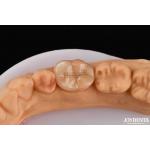 High Durability Dental Inlay Onlay Composite Natural Looking Appearance for sale