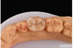 China High Durability Dental Inlay Onlay Composite Natural Looking Appearance supplier