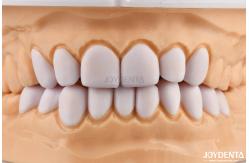 China Dental Veneers for Misaligned Teeth Biocompatibility And Gentle On Oral Tissues supplier
